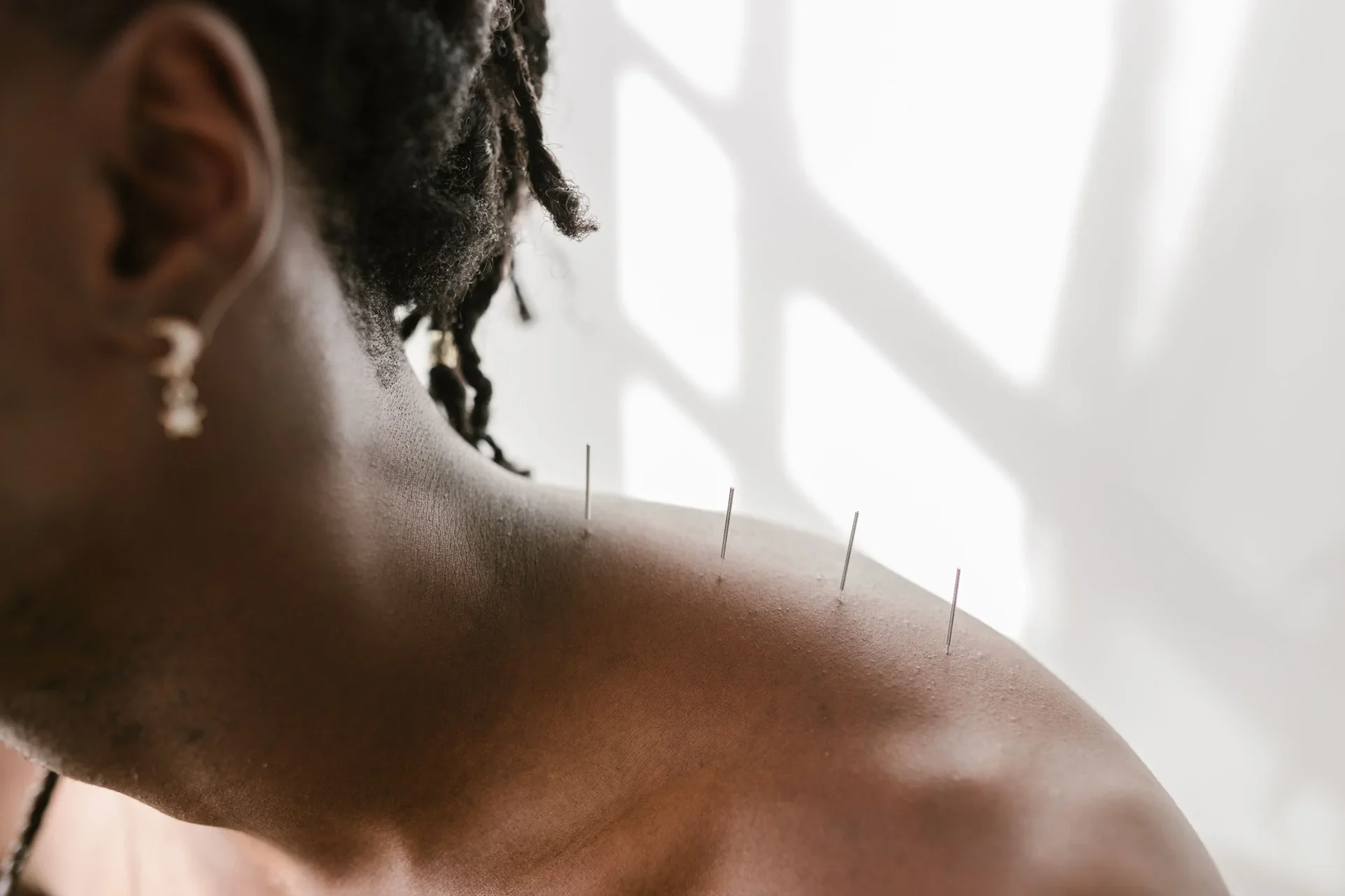 Close-up of a shoulder and upper back with several acupuncture needles inserted along the spine area.